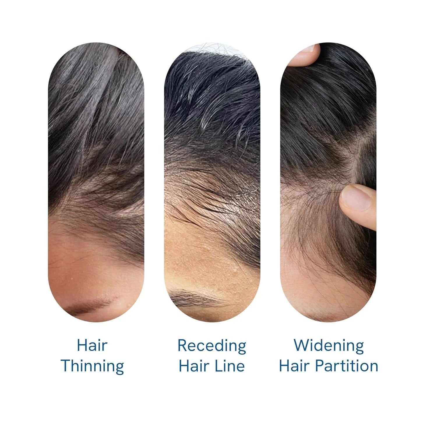 Bodywise Advanced Hair Growth Roll-On Serum | 3% Rosemary | 2% Aminexil | 3% Redensy l 2% Anagain | Precision Scalp Applicator | Paraben & Sulphate Free | Non oily and mess free